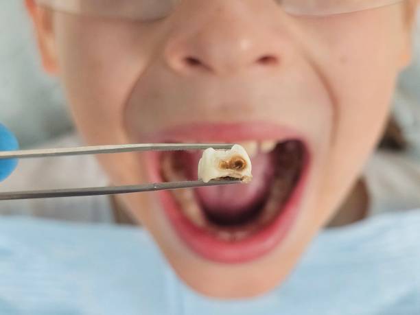 Best Emergency Tooth Extraction in Sharon, WI